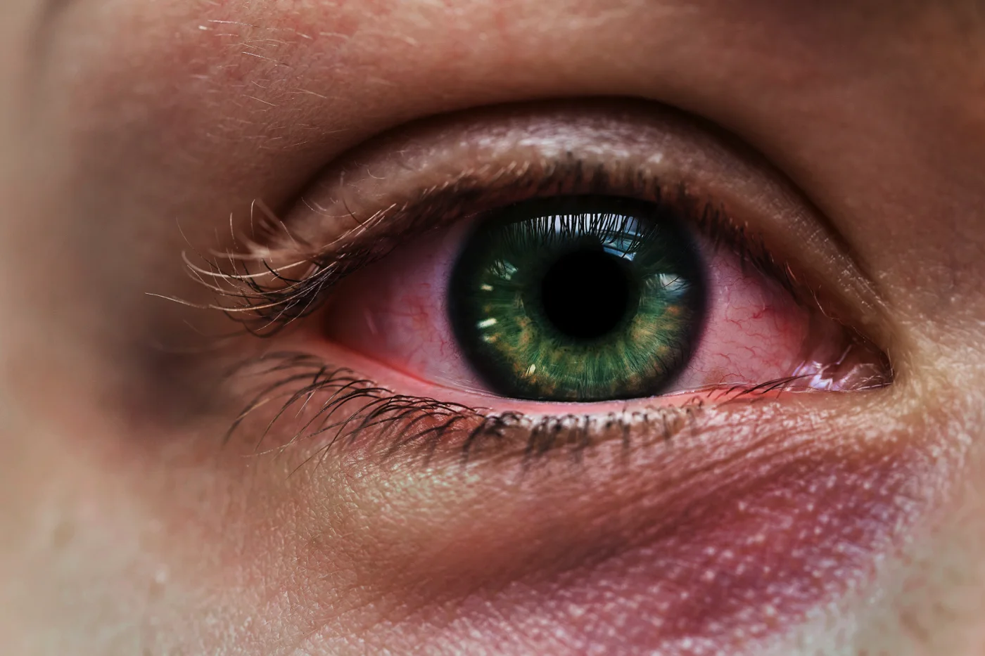 infected-female-eye-with-a-green-iris-and-subconju-2026-01-05-05-11-35-utc x 1400